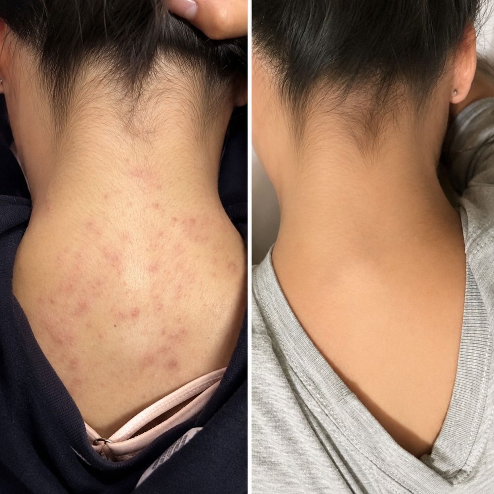 Advanced Skin treatment - Back Chemical peel - 60 min