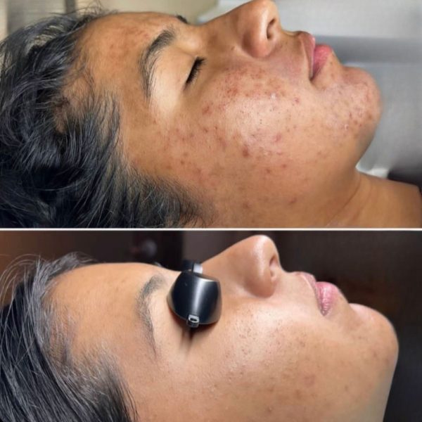 Renew facial - 75 min